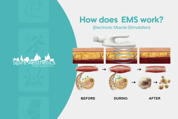 EMS treatment for post pregnancy weight loss treatment Brent
