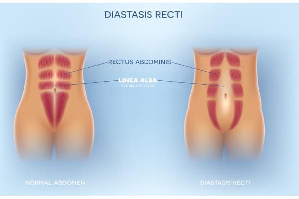 What Non-Surgical Options Are Available for Diastasis Recti Brent?