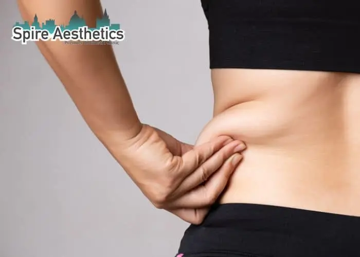Image of woman pinching fat on their hips Brent. Fat Freezing treatment