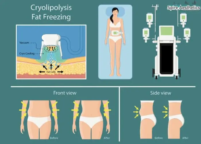 Fat freezing treatment Brent benefits for competitions to remove stubborn fat deposits.