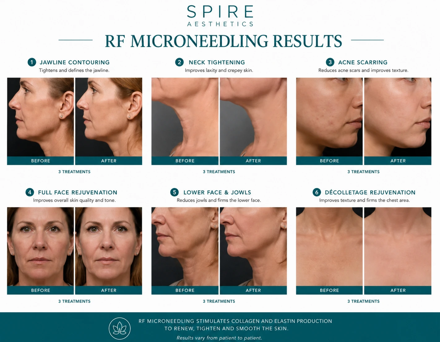 RF Microneedling Skin tightening Brent results