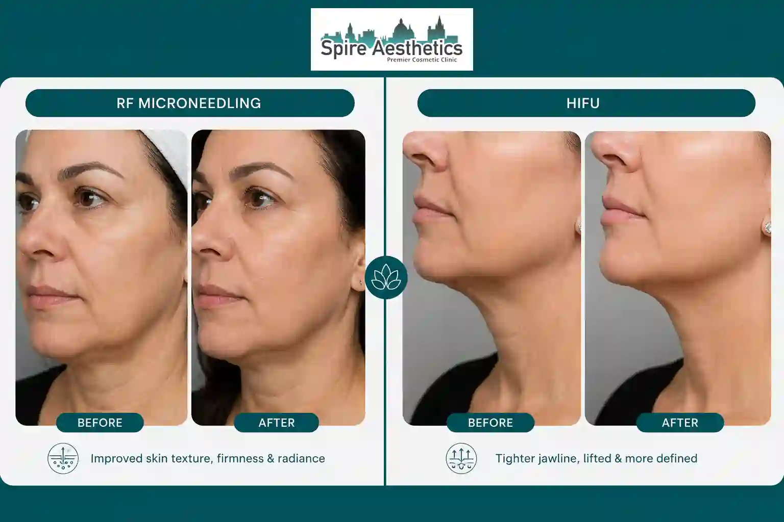 Can RF Microneedling and HIFU Be Combined Brent?