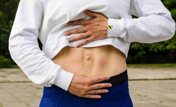 When Could Diastasis Recti Be the Missing Piece of the Puzzle Brent?