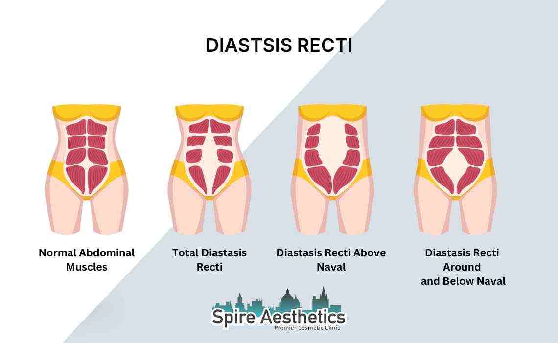 Is Non-Surgical Diastasis Recti Treatment Right for You? Common Concerns Answered Brent
